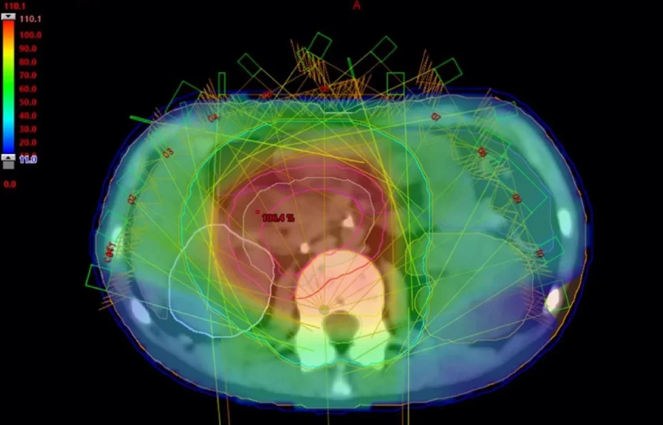 Recaídas cáncer infantil